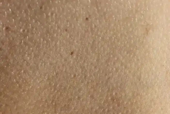 علاج جلد الوزه في المناطق الحساسه