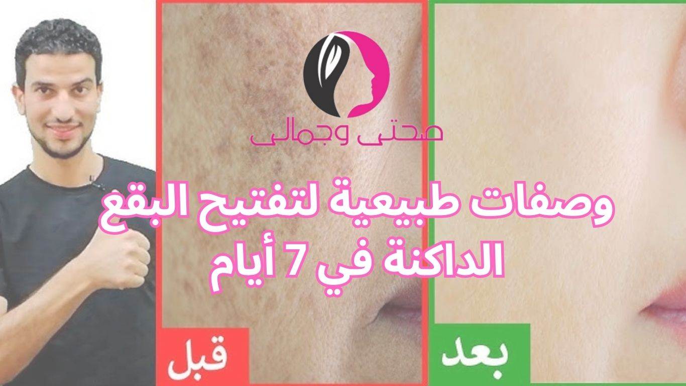 وصفات طبيعية لتفتيح البقع الداكنة في 7 أيام