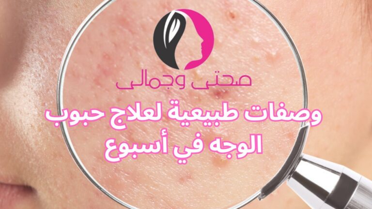 وصفات طبيعية لعلاج حبوب الوجه في أسبوع
