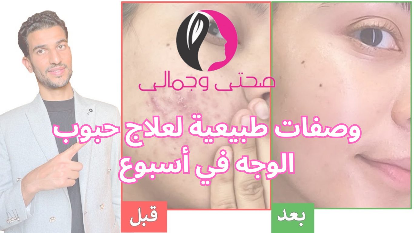وصفات طبيعية لعلاج حبوب الوجه في أسبوع