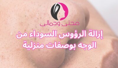 إزالة الرؤوس السوداء من الوجه بوصفات منزلية