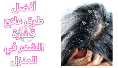 أفضل طرق علاج قشرة الشعر في المنزل