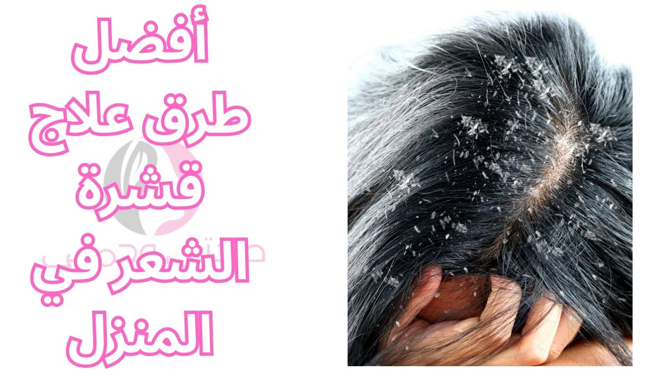 أفضل طرق علاج قشرة الشعر في المنزل