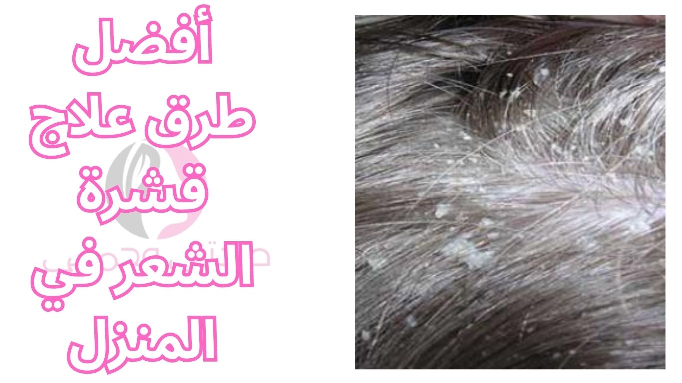 أفضل طرق علاج قشرة الشعر في المنزل