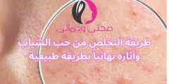 طريقة التخلص من حب الشباب وآثاره نهائياً بطريقة طبيعية