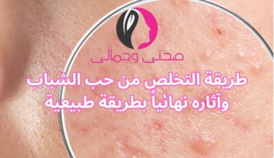 طريقة التخلص من حب الشباب وآثاره نهائياً بطريقة طبيعية