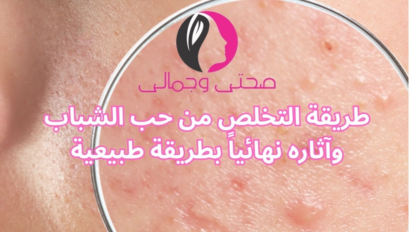 طريقة التخلص من حب الشباب وآثاره نهائياً بطريقة طبيعية