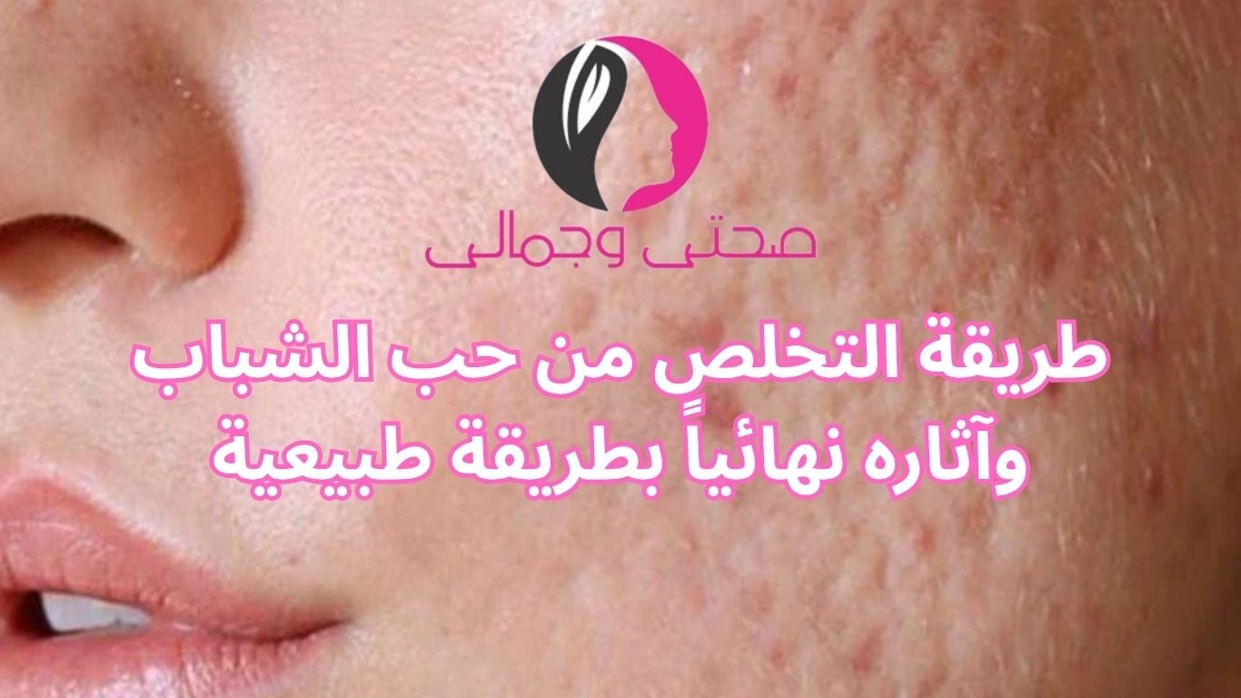 طريقة التخلص من حب الشباب وآثاره نهائياً بطريقة طبيعية