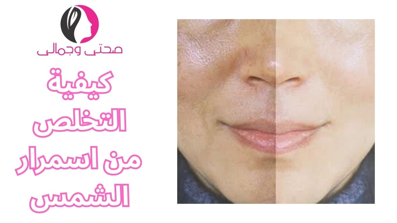 كيفية التخلص من اسمرار الشمس