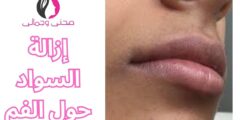 إزالة السواد حول الفم