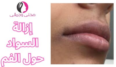إزالة السواد حول الفم