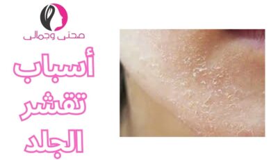 أسباب تقشر الجلد