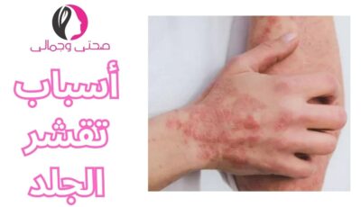 ما هو علاج الصدفية