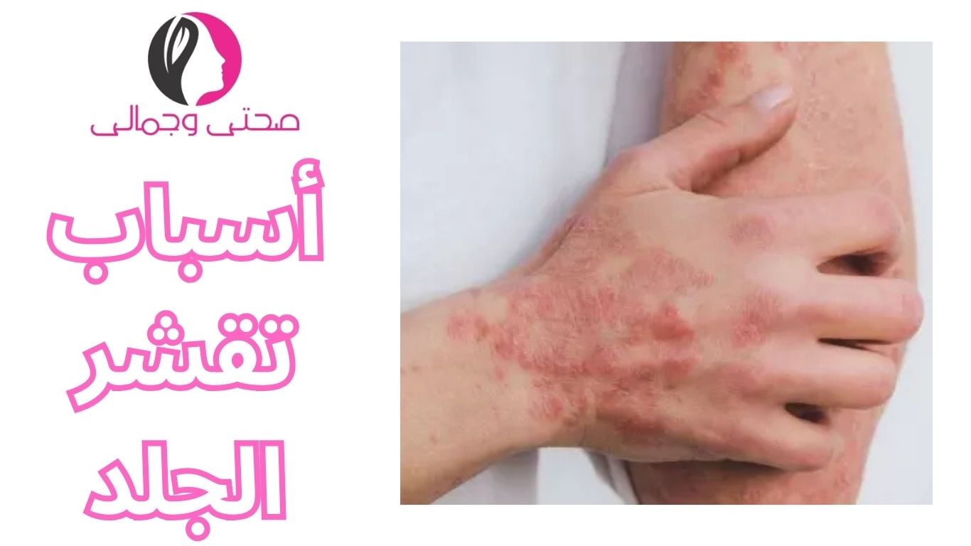 ما هو علاج الصدفية