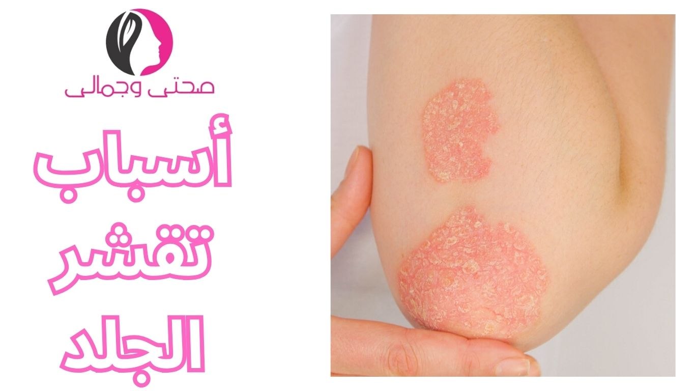 ما هو علاج الصدفية