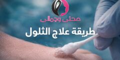 طريقة علاج الثالول