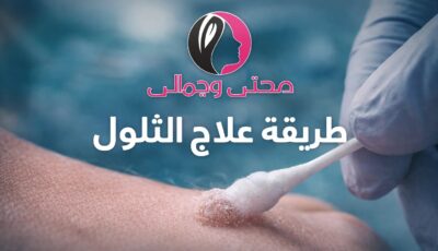 طريقة علاج الثالول