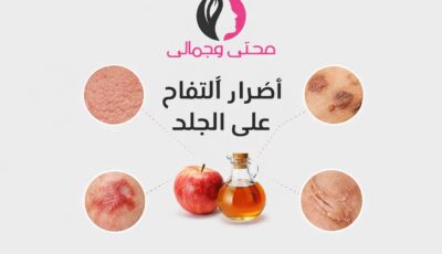 أضرار خل التفاح على الجلد