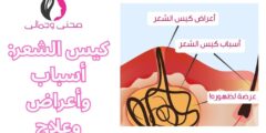 كيس الشعر: أسباب وأعراض وعلاج
