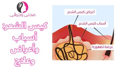 كيس الشعر: أسباب وأعراض وعلاج