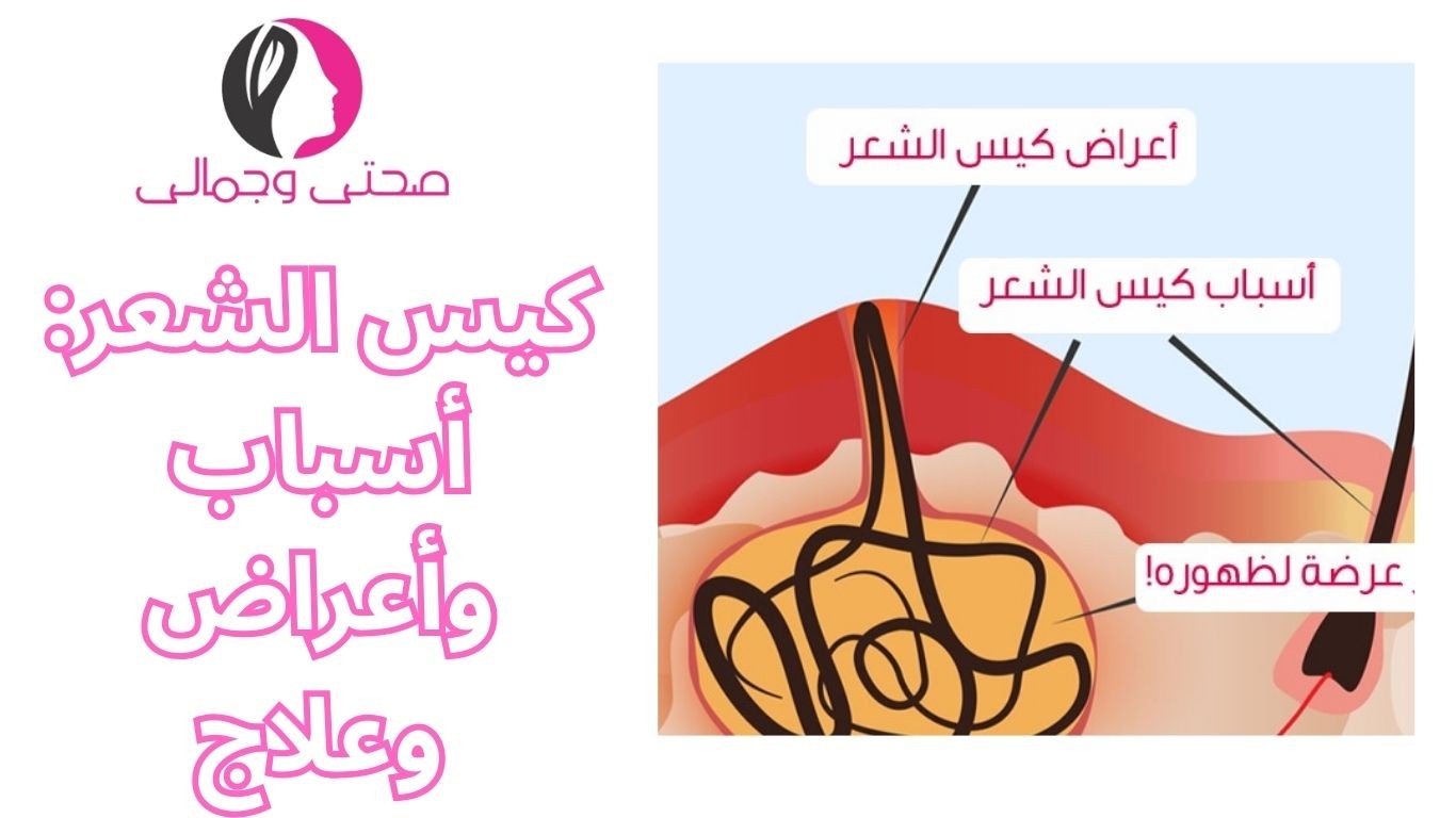 كيس الشعر: أسباب وأعراض وعلاج