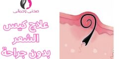 علاج كيس الشعر بدون جراحة