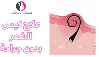 علاج كيس الشعر بدون جراحة
