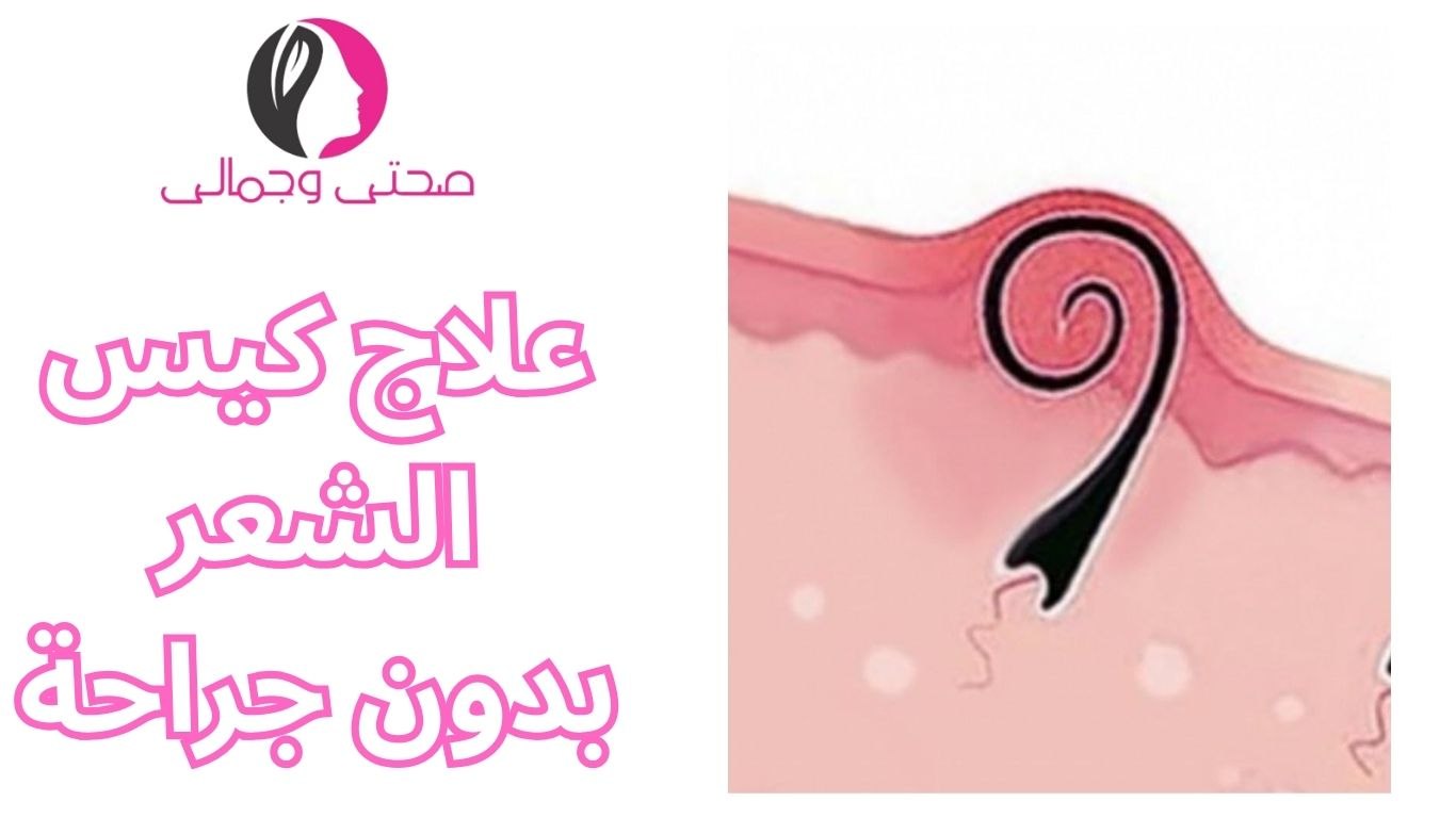 علاج كيس الشعر بدون جراحة