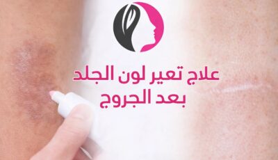 علاج تغير لون الجلد بعد الجروح