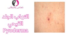 التهاب الجلد القيحي Pyoderma