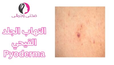 التهاب الجلد القيحي Pyoderma