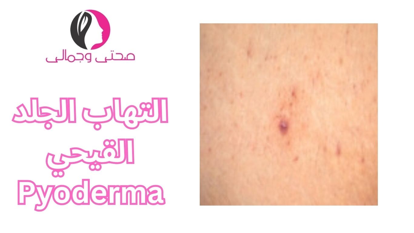 التهاب الجلد القيحي Pyoderma