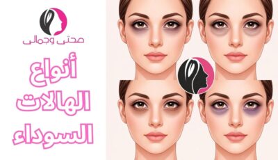 أنواع الهالات السوداء