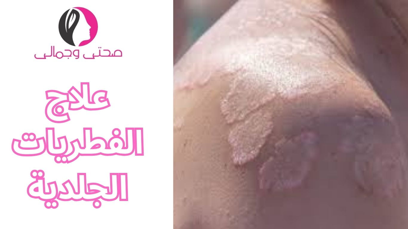 علاج الفطريات الجلدية