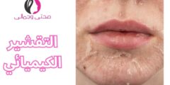 التقشير الكيميائي