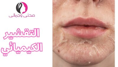 التقشير الكيميائي