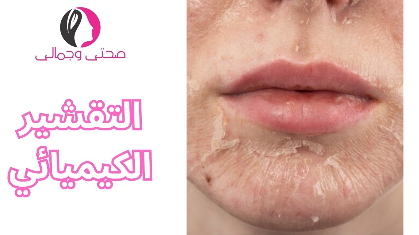 التقشير الكيميائي