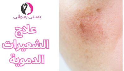 علاج الشعيرات الدموية