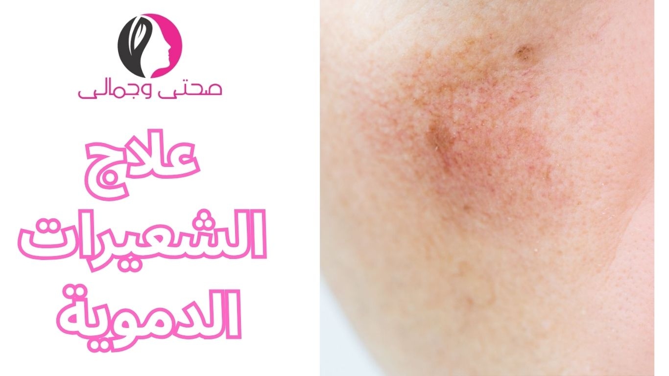 علاج الشعيرات الدموية 