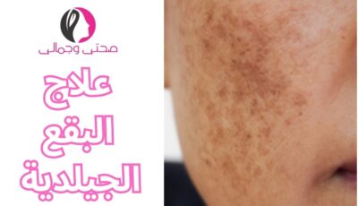 علاج البقع الجيلدية