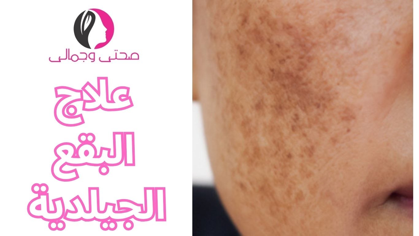 علاج البقع الجيلدية