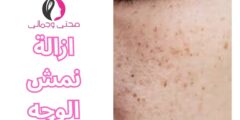 ازالة نمش الوجه