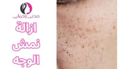 ازالة نمش الوجه