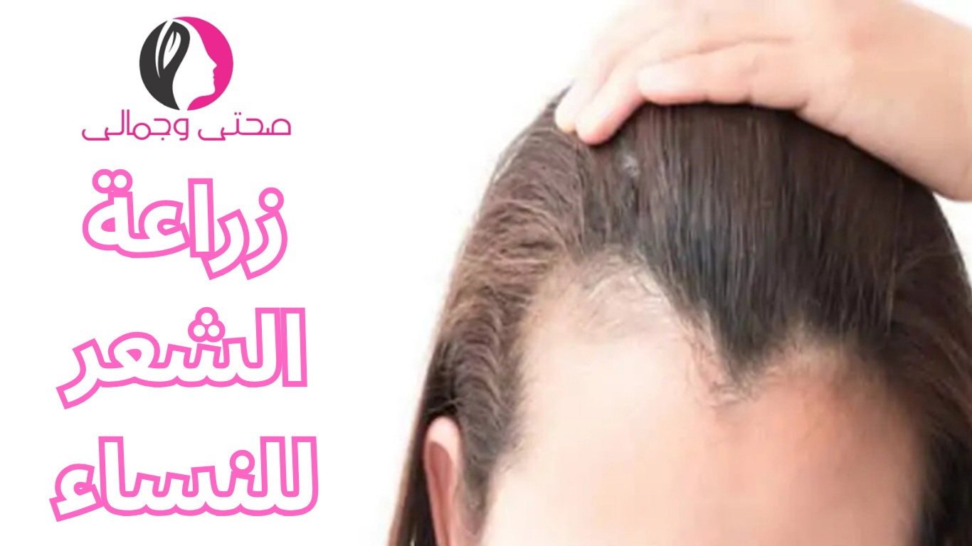 زراعة الشعر للنساء
