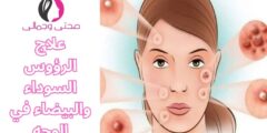 علاج الرؤوس السوداء والبيضاء في الوجه