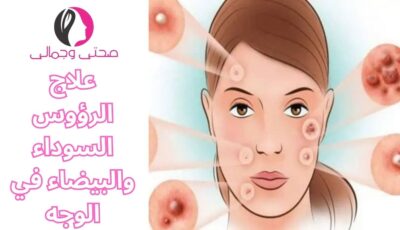 علاج الرؤوس السوداء والبيضاء في الوجه