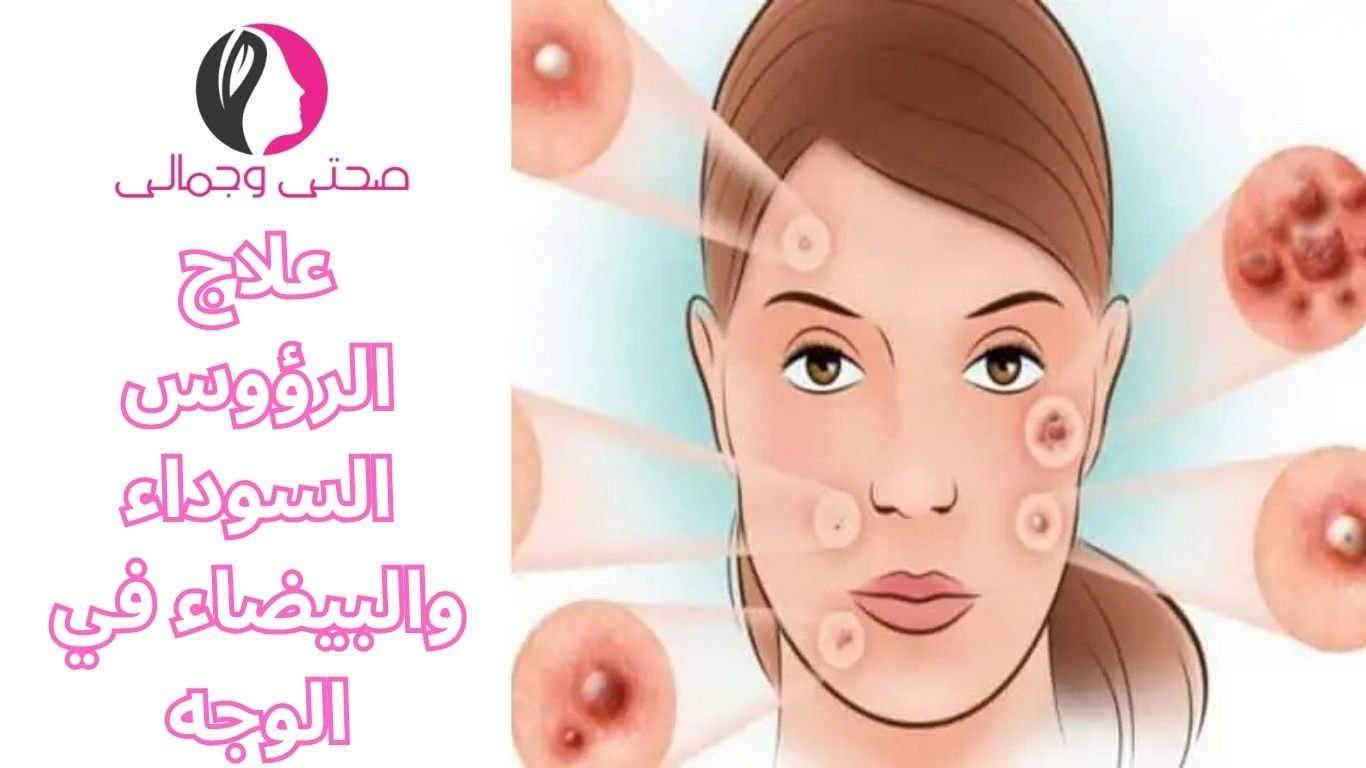 علاج الرؤوس السوداء والبيضاء في الوجه