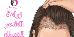 زراعة الشعر للنساء مميزات والعيوب
