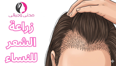 زراعة الشعر للنساء مميزات والعيوب